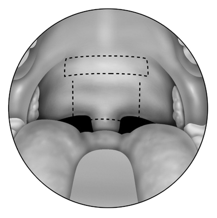 Showing schematic incisions for the Anterior Palatoplasty