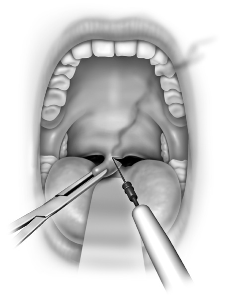 Showing the trimming of the uvula