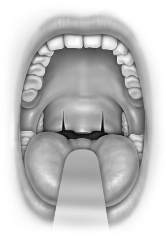 Showing the division of the posterior webs of the palate arches