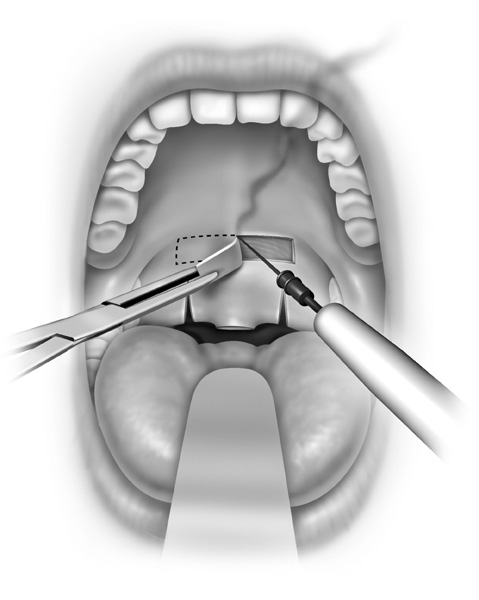 Removing the mucosa rectangular box on the front surface of the soft palate