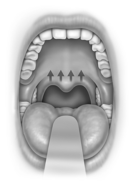 Final end result, a nice superior/upward increase in the airway space